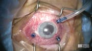 Subfoveal PFO Removal With Soft-Tip Cannula