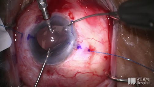 Reposition of a Gore-Tex—Fixated IOL