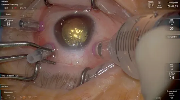 Unity VCS: 27Ga – Silicone Oil Injection thumbnail