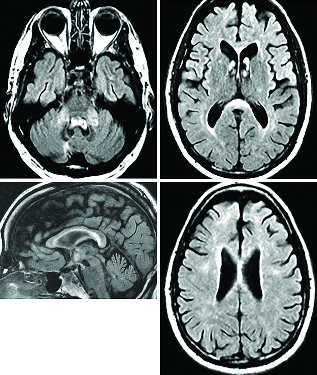 Fragile X Ataxia Syndrome Misdiagnosed As Multiple Sclerosis - The