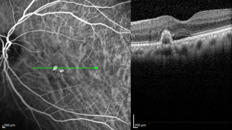 Diagnosing PCV With OCT B-Scan - Retina Today