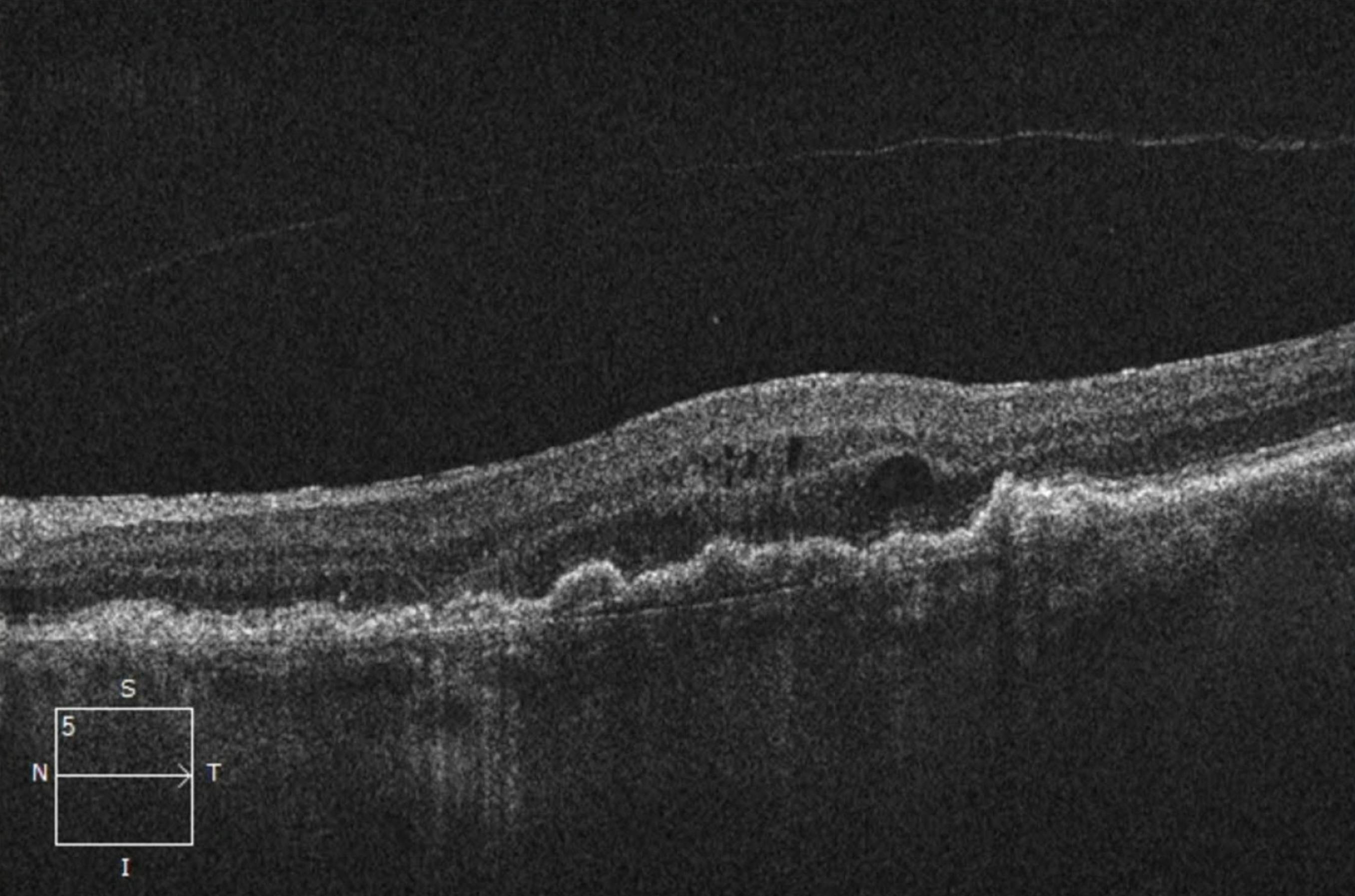 Managing Wet AMD: The Promise of TKIs - Retina Today