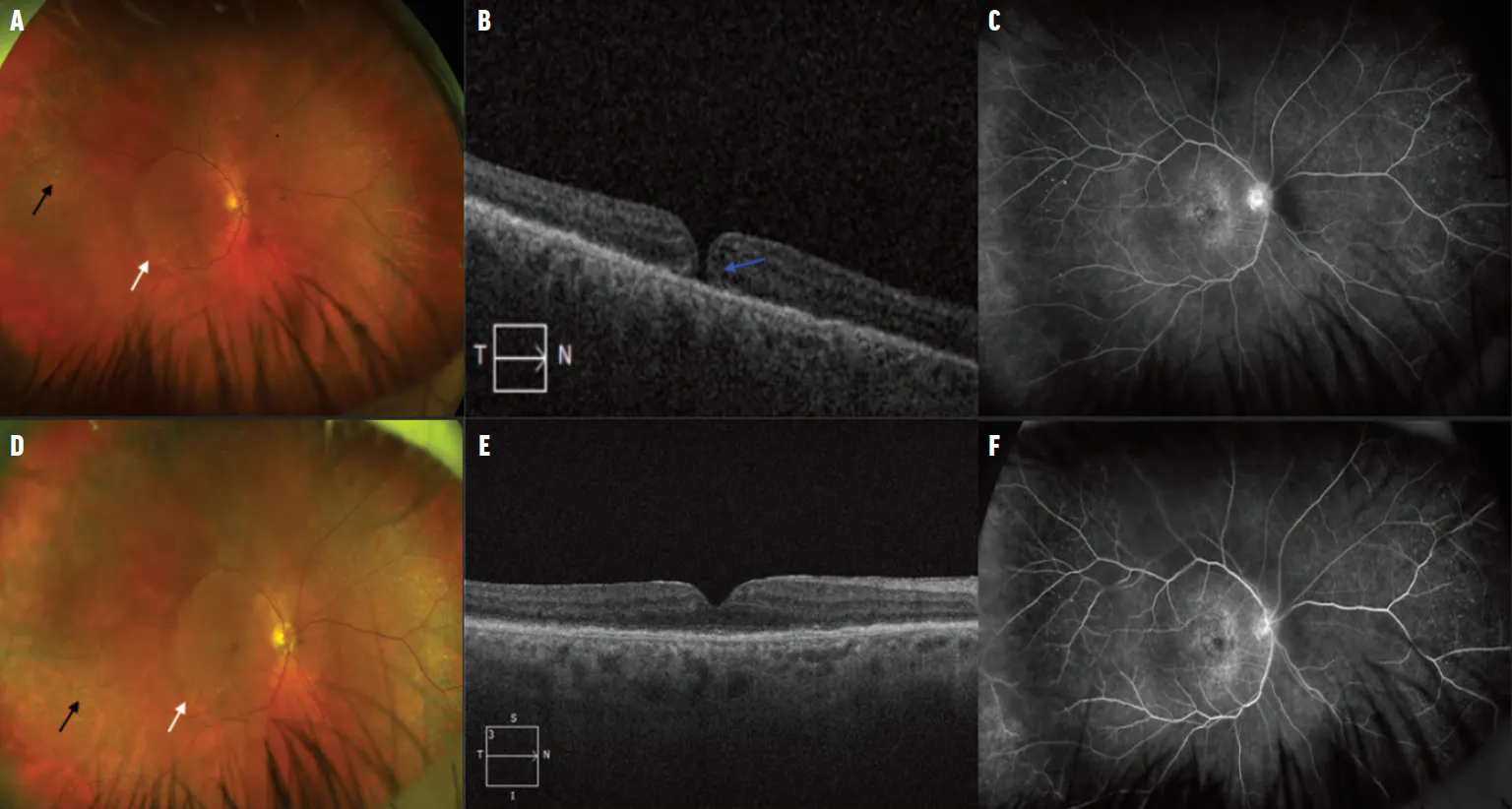 Posterior Placoid Changes Due to Nutritional Deficiency - Retina Today
