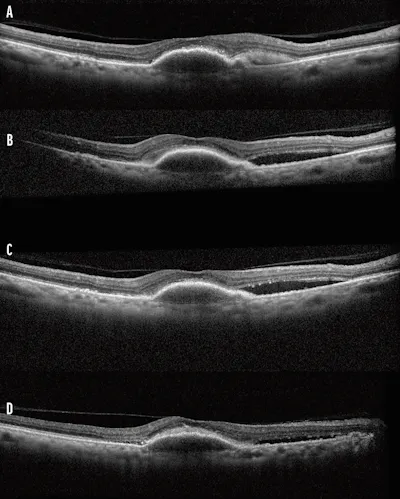 Anti-VEGF Step Therapy: An Update image