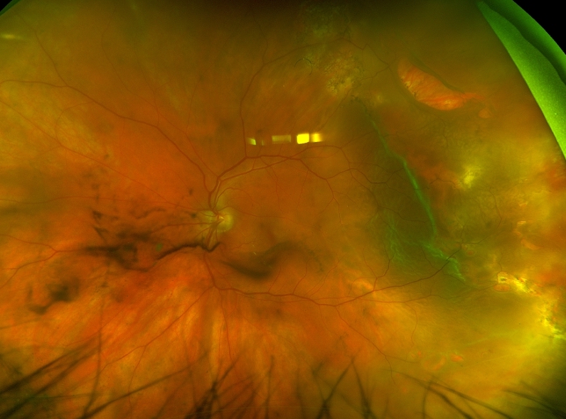 New Concepts In Proliferative Vitreoretinopathy - Retina Today