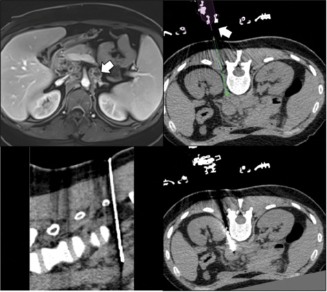 Robotics in Interventional Oncology: The Next Frontier in Image-Guided ...