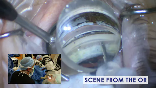 Refractive Considerations in a Glaucomatous Eye