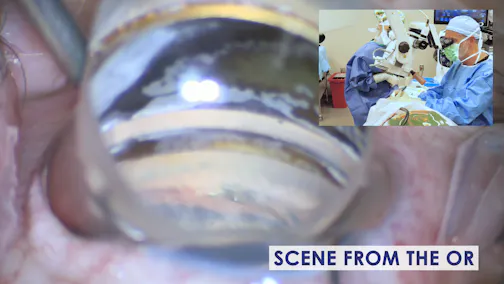 Treatment Considerations for a Patient With Cataracts and Normal-Tension Glaucoma