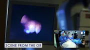 Angle-Based MIGS for a Patient With Severe Glaucoma