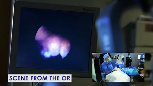 Angle-Based MIGS for a Patient With Severe Glaucoma