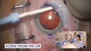 Cataract Surgery With a Pre-Existing Filtering Bleb