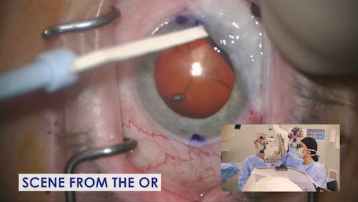 Cataract Surgery With a Pre-Existing Filtering Bleb