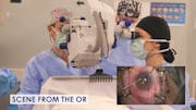 Optimizing Existing Tube Shunt in Uveitic Glaucoma