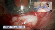Revision of an Ischemic Focal Bleb