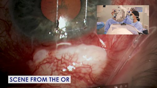 Revision of an Ischemic Focal Bleb