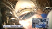 Phacoemulsification and iTrack Advance Canaloplasty