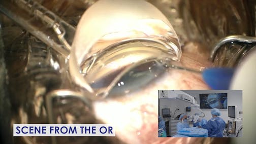Phacoemulsification and iTrack Advance Canaloplasty