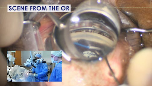 Inside a Complex Glaucoma Case: MIGS and Managing the Unexpected