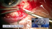 Xen Gel Stent Revision and Ahmed Valve Implantation