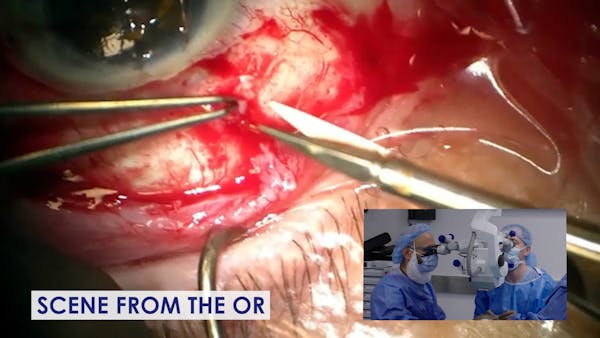 Xen Gel Stent Revision and Ahmed Valve Implantation thumbnail