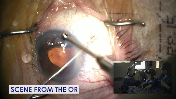 Xen Gel Stent Implantation Pearls thumbnail
