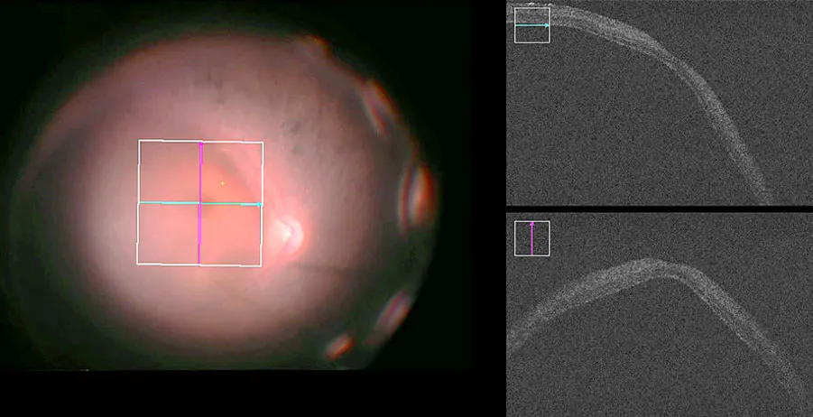 Current Subretinal Gene Therapy Delivery - Retina Today