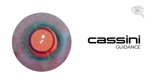 Intraoperative Digital Marking with Cassini Surgical Guidance