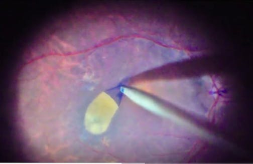 ILM Tear-and-Lift Technique for Macular Holes With Nonexpansive SF6 Gas