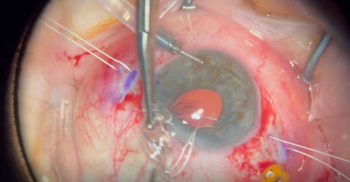 Sutured Envista MX60E