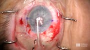 Corneal Edema in the Context of an Anterior Chamber IOL