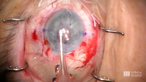 Corneal Edema in the Context of an Anterior Chamber IOL
