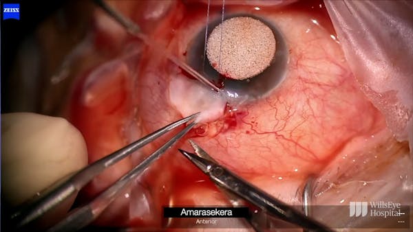 Choroidal Drainage and Repair of Bleb Leak thumbnail