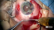 Yamane Technique and Iris Repair in Case of Trauma