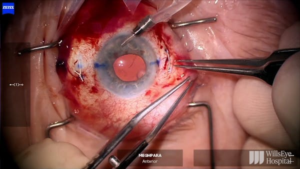 Gore-Tex Sutured Envista Envy thumbnail