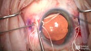 Management of Extensive Cyclodialysis Clefts