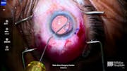 Prolene Suture Fixation of Capsular Tension Segment During Lens Exchange