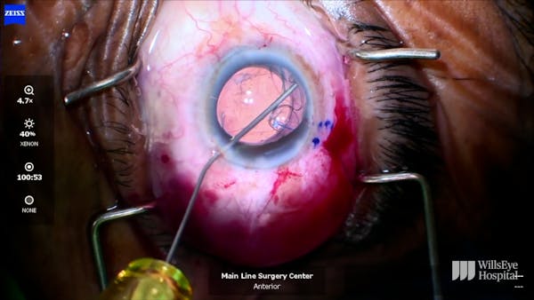 Prolene Suture Fixation of Capsular Tension Segment During Lens Exchange thumbnail