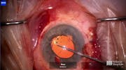 Surgical Repair of Irido-Cyclodialysis Cleft