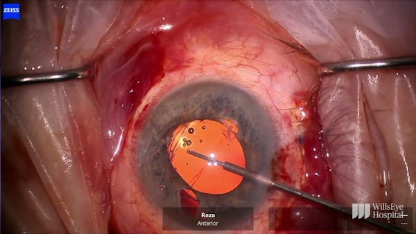 Surgical Repair of Irido-Cyclodialysis Cleft thumbnail