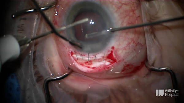 Management of Traumatic Crystalline Subluxation thumbnail