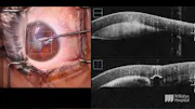 Iris-Fixated PMMA Phakic IOL Explantation During Cataract Surgery