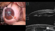 Intraoperative OCT for Corneal Cyst Removal