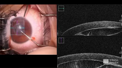 Intraoperative OCT for Corneal Cyst Removal