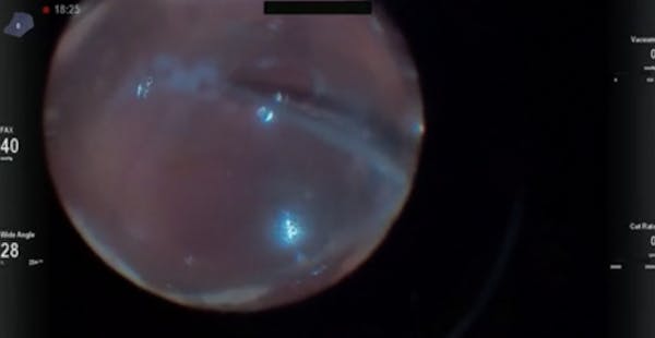 Inferior Retinal Detachment thumbnail