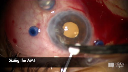 Amniotic Membrane for Recalcitrant Macular Hole