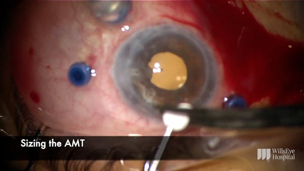 Amniotic Membrane for Recalcitrant Macular Hole thumbnail
