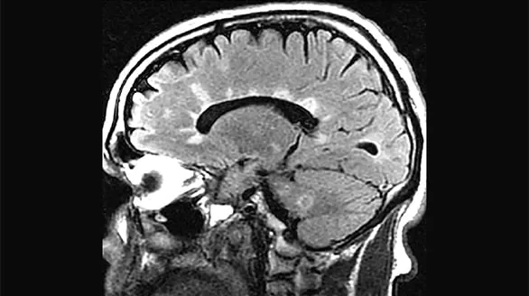 MS The Latest: imaging and testing