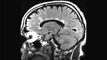 MS The Latest: imaging and testing