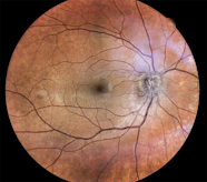 Optic Neuritis