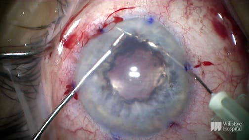 TASS After Cataract Surgery